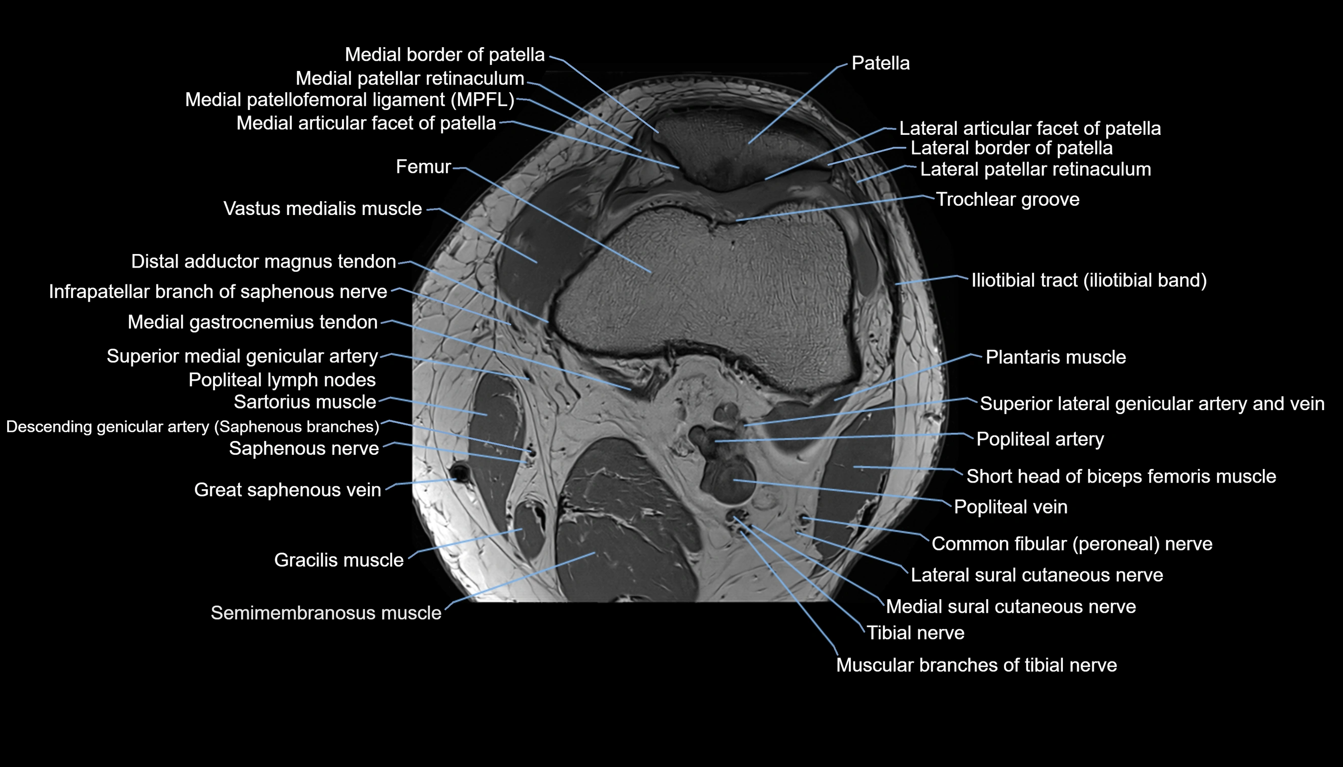 MRI knee  axial cross sectional anatomy 3T radiology  image-img-00001-00013.webp